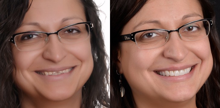 Claudia prima e dopo il trattamento con le faccette