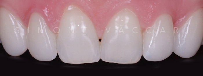 Giovanna faccette dopo