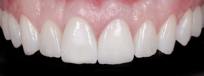 Paolo dopo le faccette