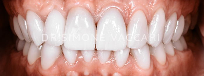 faccette dentali dopo