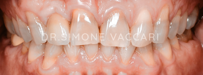 faccette dentali prima