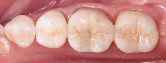 otturazioni in composito prima e dopo 2020