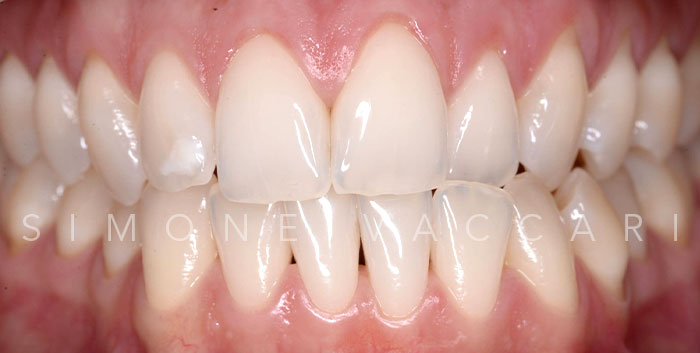 Parodontite Salvare I Denti Naturali Caso 3 Dopo