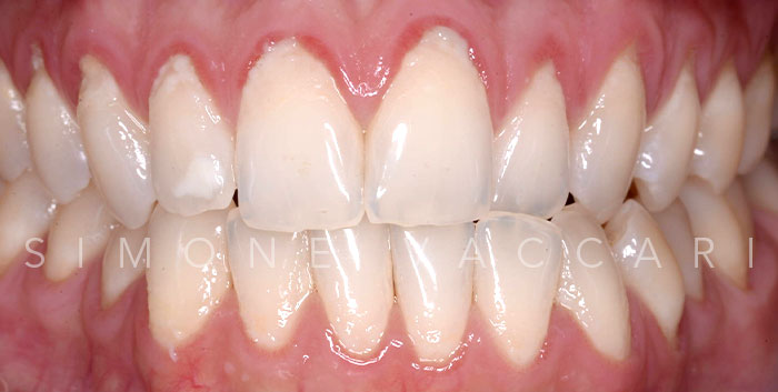 Parodontite Salvare I Denti Naturali Caso 3 Prima