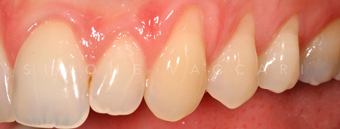 Chirurgia Plastica Parodontale Caso 2 PRIMA