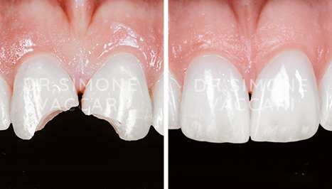 Dente rotto: prima vs dopo