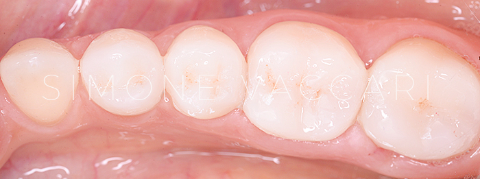 denti consumati prima e dopo