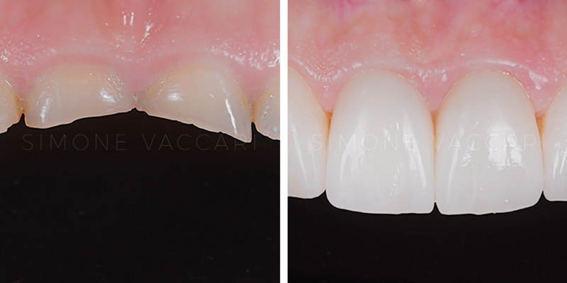 denti corti faccette dentali