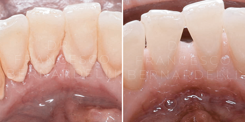 parodontite giovanile prima e dopo