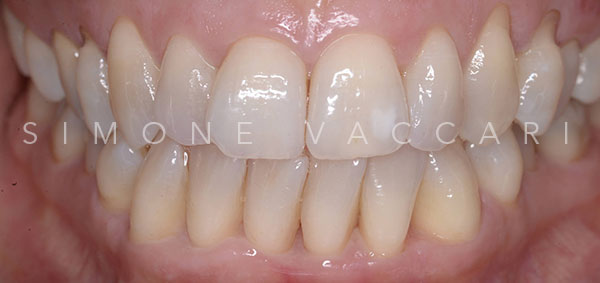 Simone Vaccari Parodontite E Stili Di Vita Denti Dopo
