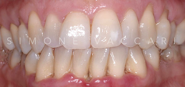 Simone Vaccari Parodontite E Stili Di Vita Denti Prima