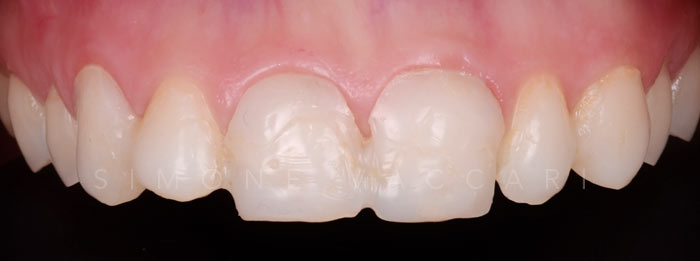 Sefora prima delle faccette dentali