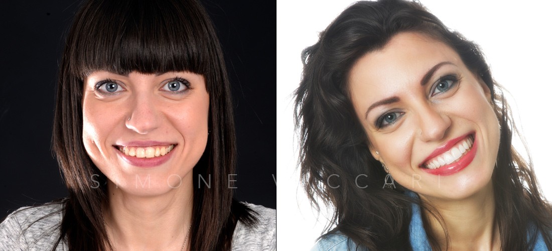 Sefora prima e dopo il trattamento con le faccette