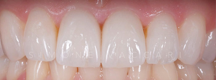 Faccette dentali -Dopo