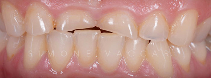 Faccette dentali -Prima