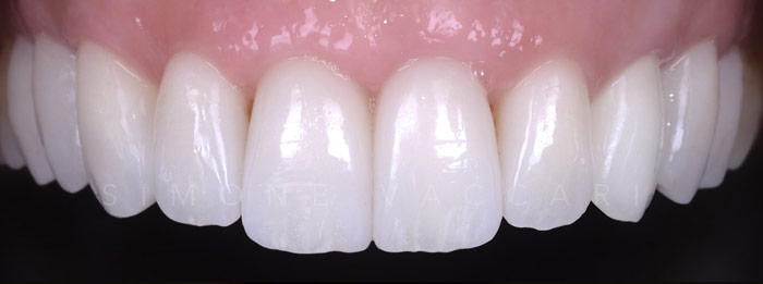 Simone Vaccari Faccette Dentali TINA Denti Prima
