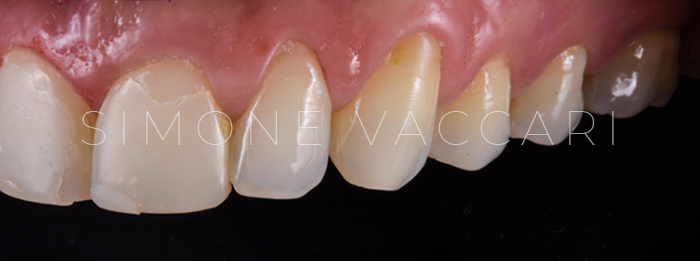 chipping denti dx