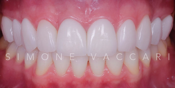 Federica p dopo il trattamento con le faccette