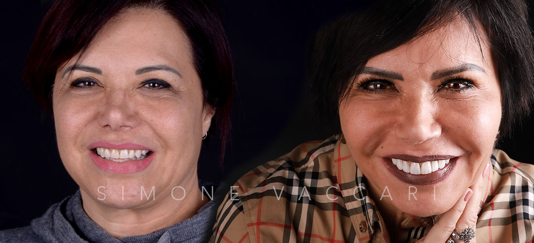 Prima e dopo di Giovanna con le faccette