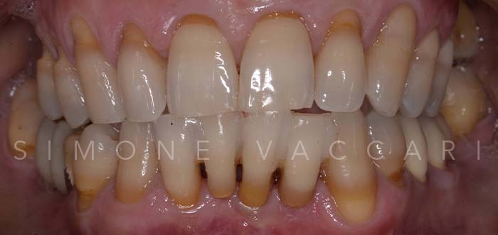 Metti Al Sicuro I Tuoi Denti Naturali Per I Prossimi 30 Anni Caso 2 Dopo