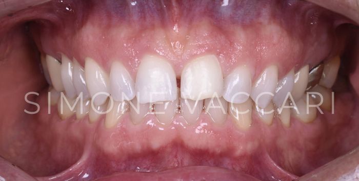 Dente devitalizzato dopo lo sbiancamento
