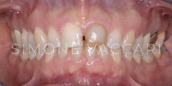 dente devitalizzato scuro prima dello sbiancamento