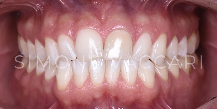 dente devitalizzato dopo sbiancamento walking bleach