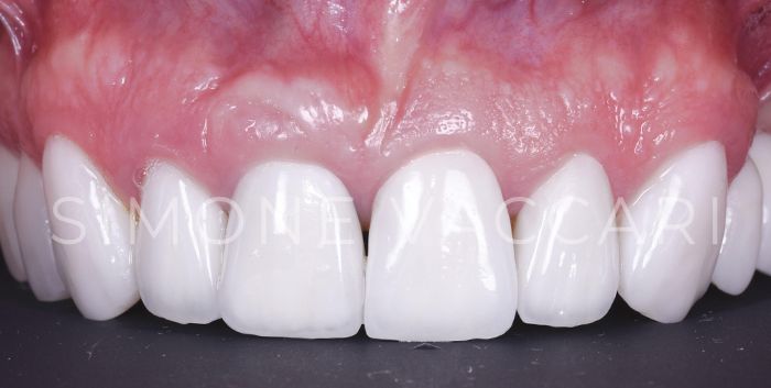Dente devitalizzato dopo trattamento faccette