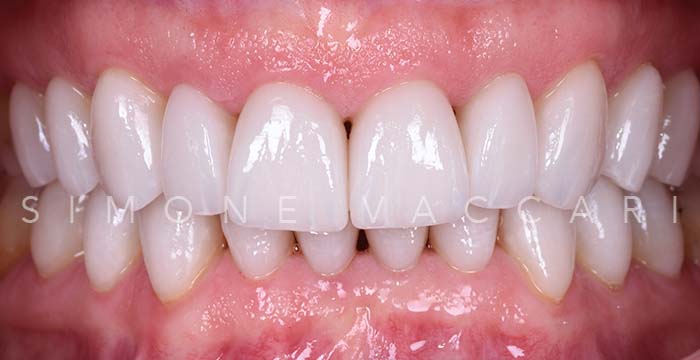 Massimiliano dopo le faccette