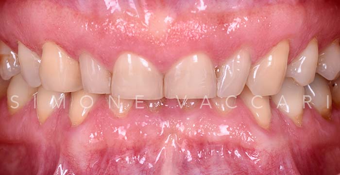 Massimiliano prima delle faccette