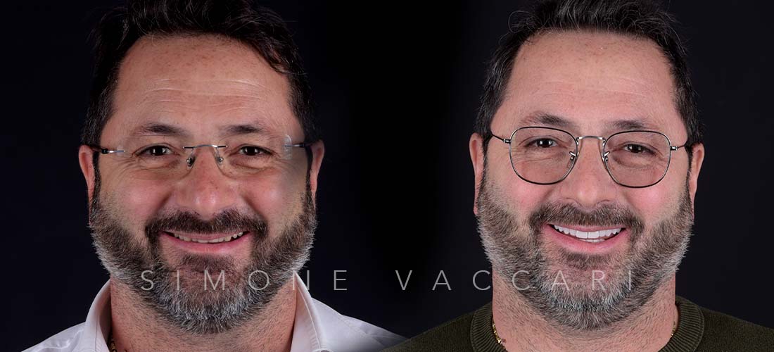 Massimiliano prima e dopo il trattamento con le faccette