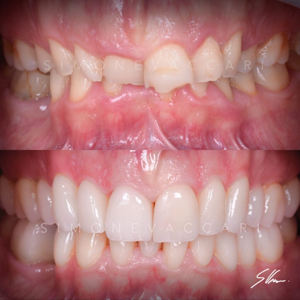altro esempio di risultato ottenuto con le faccette estetiche