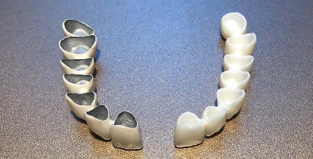 comparazione zirconia-metallo-ceramica