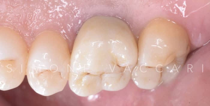 Dente dopo l'applicazione della corona in ceramica integrale