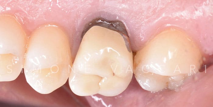 dente prima dell'applicazione della corona in ceramica integrale
