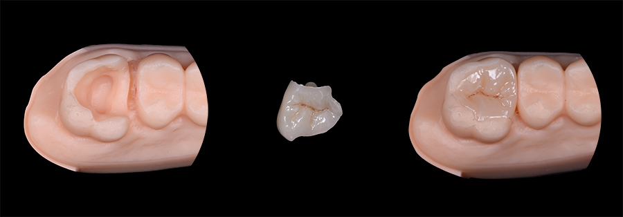 un intarsio dentale realizzato presso il nostro Studio di Modena