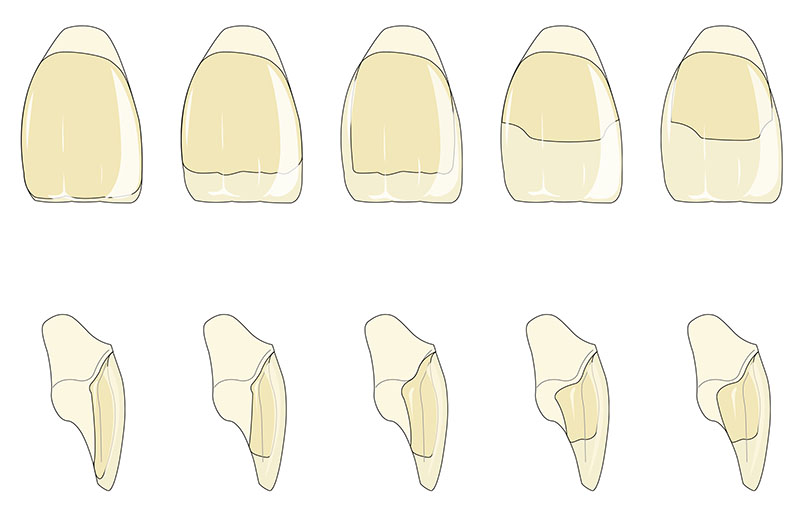 faccette dentali di fronte e di profilo