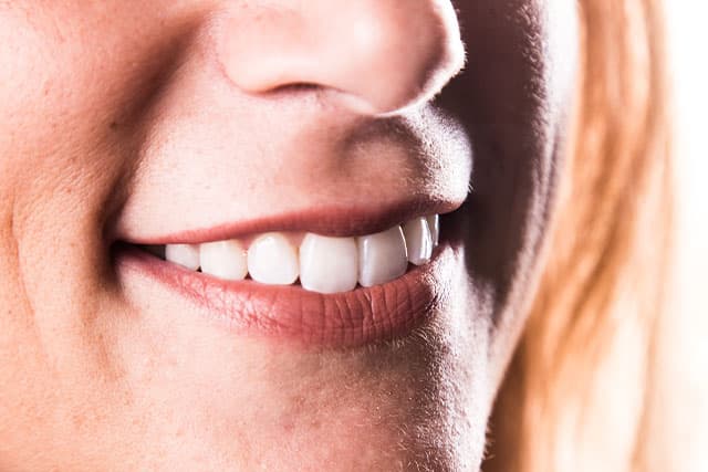 Risultato di un trattamento con le faccette dentali presso il nostro studio