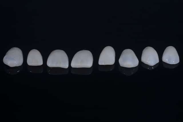Un set di faccette dentali 