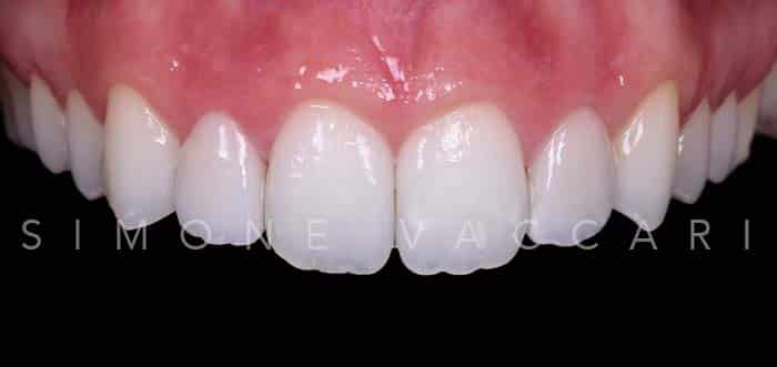 Francesca dopo le faccette dentali