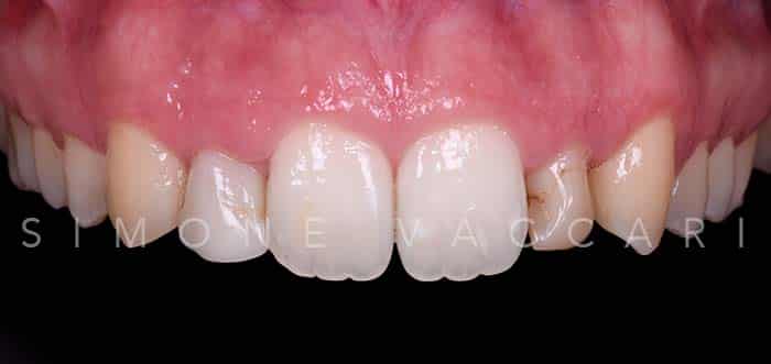 Francesca prima delle faccette dentali