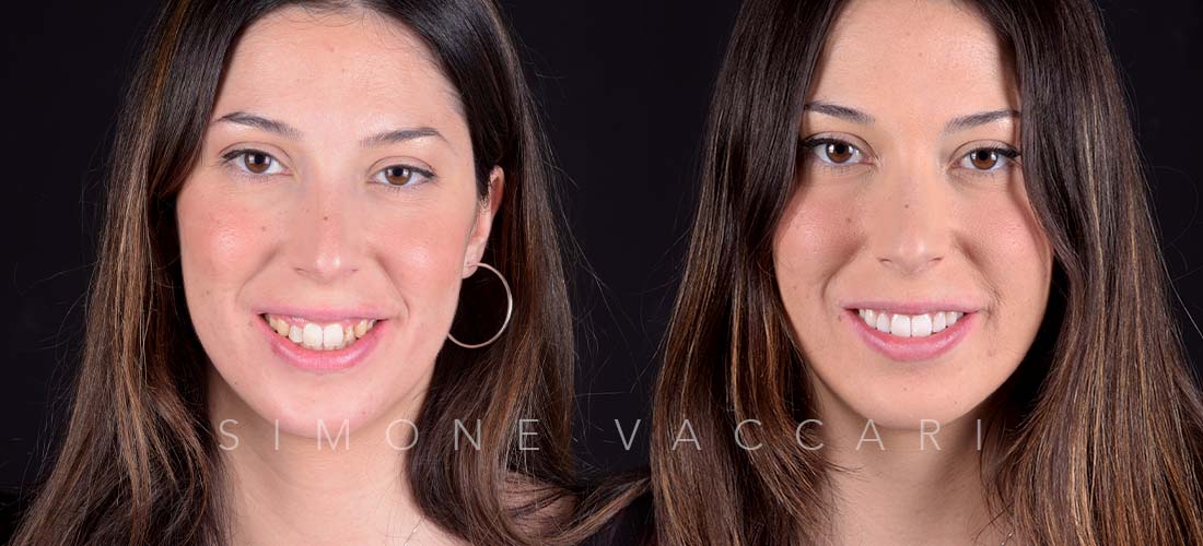 Francesca prima e dopo il trattamento con le faccette