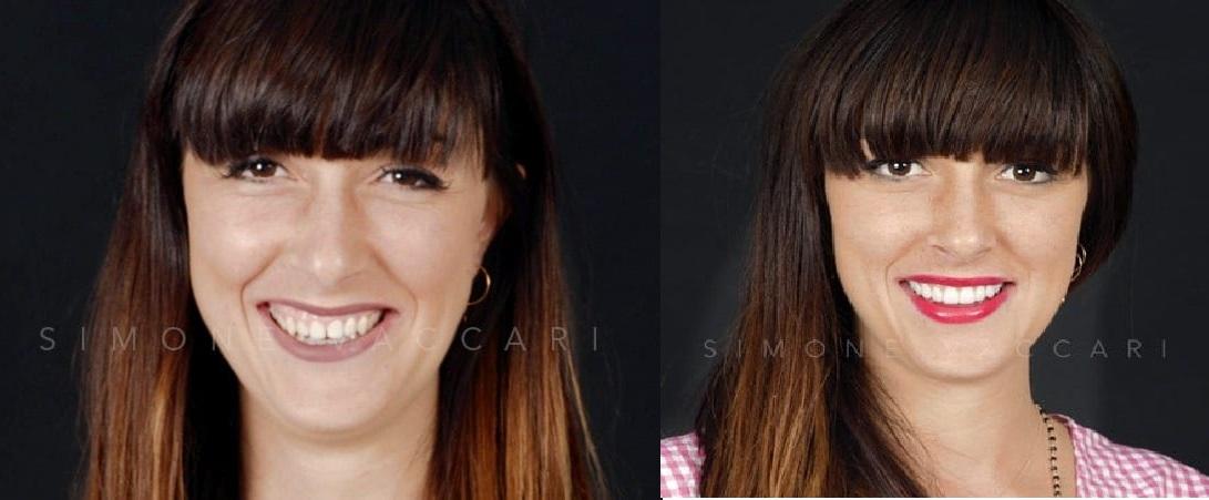 Samantha prima e dopo il trattamento con le faccette