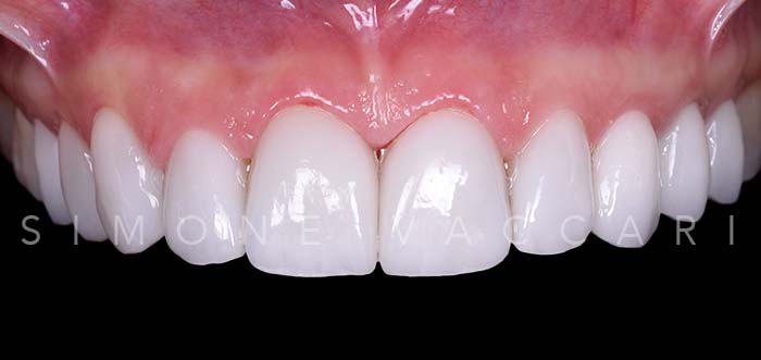 Alice S dopo del trattamento con le faccette dentali dettaglio dentatura superiore