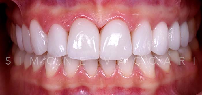 Alice S dopo il trattamento con le faccette dentali dettaglio dentatura