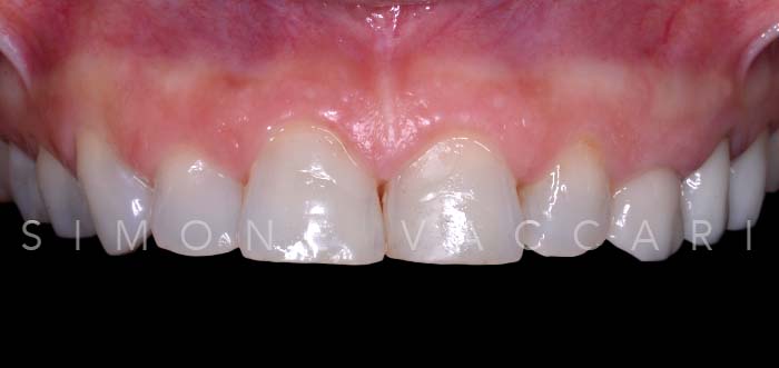 Alice S prima del trattamento con le faccette dentali dettaglio dentatura superiore