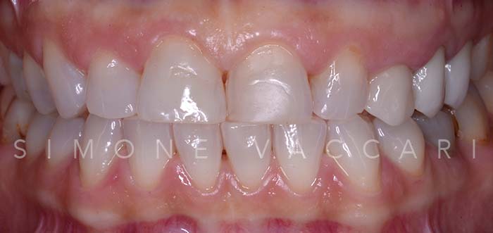 Alice S prima del trattamento con le faccette dentali dettaglio dentatura