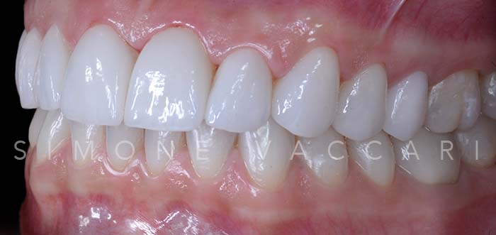 Alice S dopo del trattamento con le faccette dentali dettaglio dentatura laterale