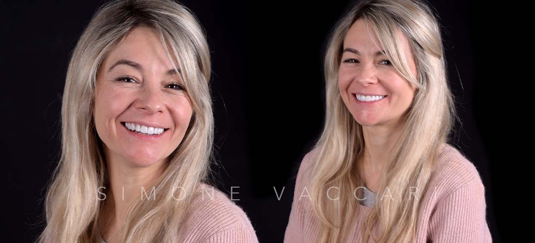 Alice dettagli del viso dopo il trattamento con le faccette
