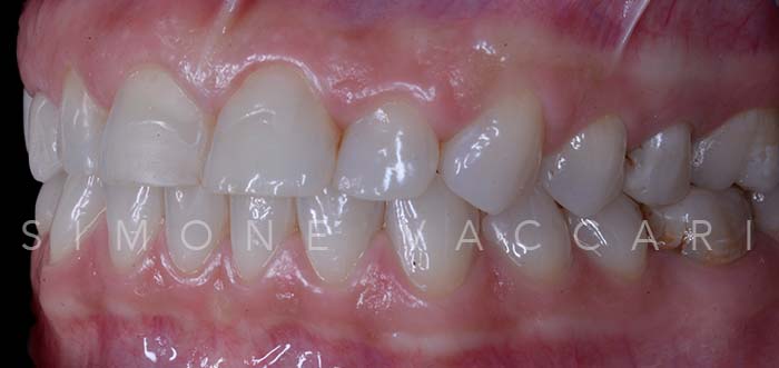 Alice S prima del trattamento con le faccette dentali dettaglio dentatura laterale